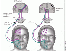 عوامل فلج بلز