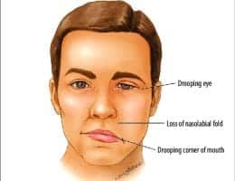 فلج بلز چیست